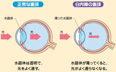 日帰り白内障手術