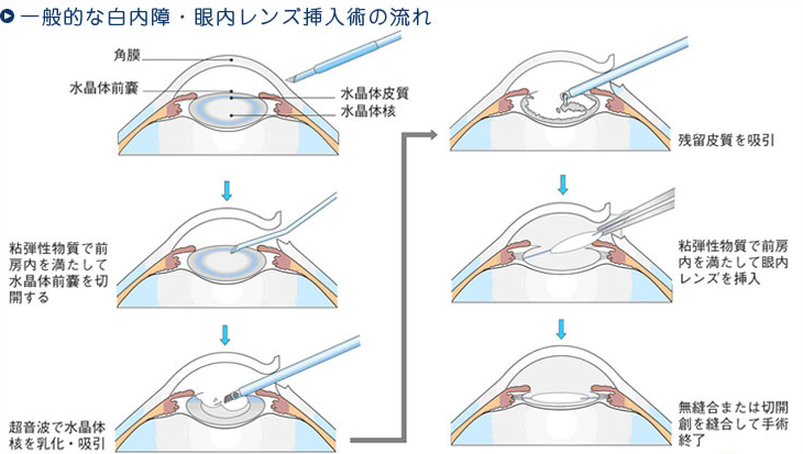 白内障手術